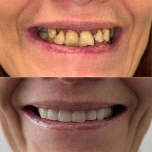 Veneers - before after