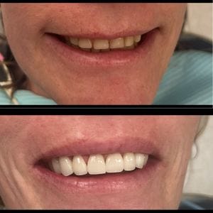 Veneers - before after1