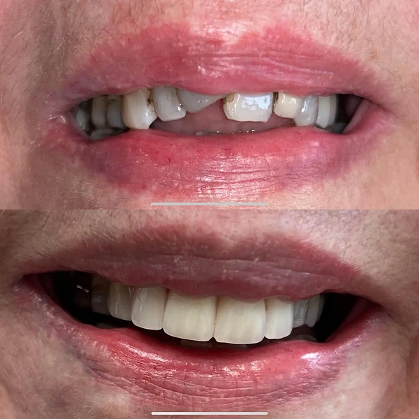 ceremic-veneers-2
