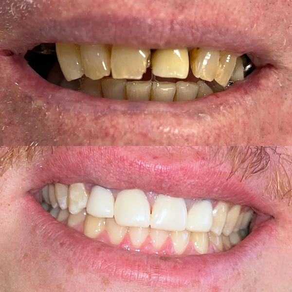 ceremic-veneers-3