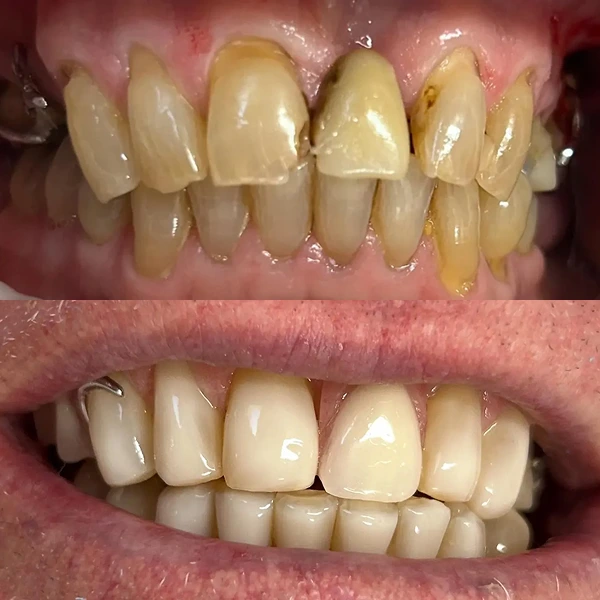 ceremic-veneers
