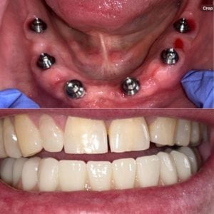 implant