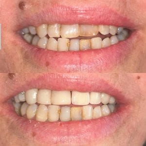 veneers 2