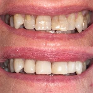 veneers- 3
