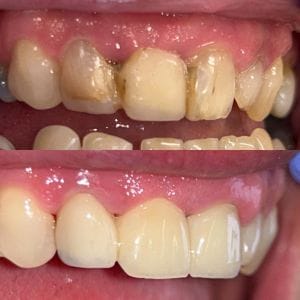 veneers- 4